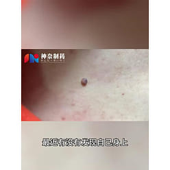 神奈制药 扁平疣软膏 小肉粒寻常疣凝胶膏1支 20 克