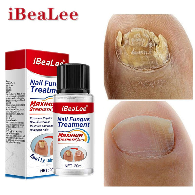 iBeaLee Onychomycosis Antibacterial Liquid Onychomycosis Special Medicine 1 개입